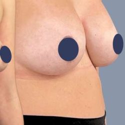 Breast Augmentation Before & After Patient #9107
