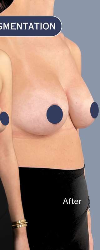 Breast Augmentation Before & After Patient #9107