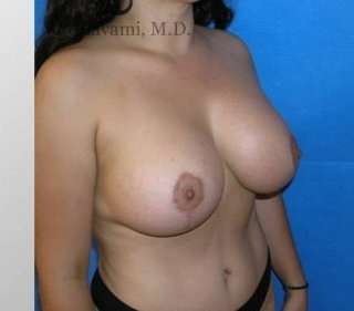 Breast Lift Before & After Patient #8840