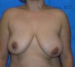 Breast Lift Before & After Patient #8840