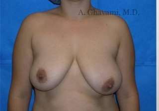 Breast Lift Before & After Patient #8840