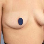 Breast Augmentation Before & After Patient #9107