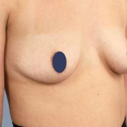 Breast Augmentation Before & After Patient #9107