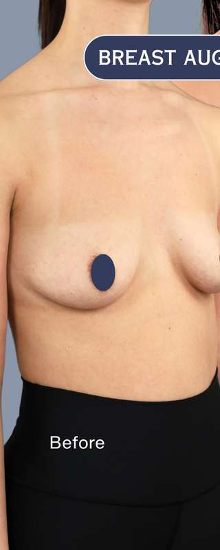 Breast Augmentation Before & After Patient #9107