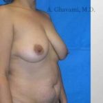 Breast Lift Before & After Patient #8840