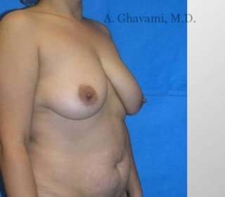 Breast Lift Before & After Patient #8840
