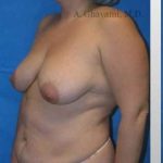 Breast Lift Before & After Patient #8840