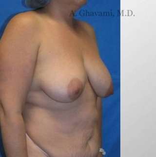 Breast Lift Before & After Patient #8840