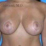 Breast Lift Before & After Patient #8831