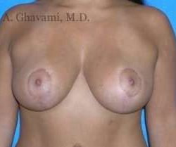 Breast Lift Before & After Patient #8831