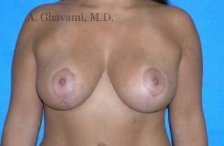 Breast Lift Before & After Patient #8831