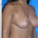 Breast Lift Before & After Patient #8831