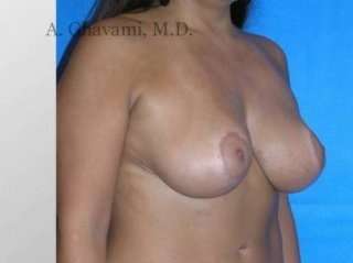 Breast Lift Before & After Patient #8831