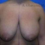 Breast Lift Before & After Patient #8831