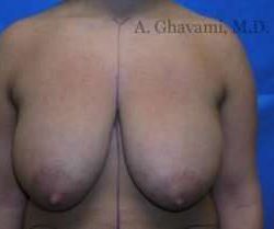 Breast Lift Before & After Patient #8831
