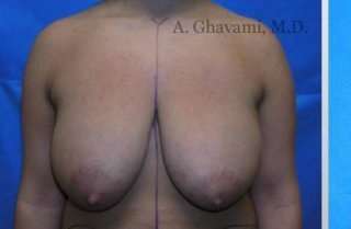 Breast Lift Before & After Patient #8831