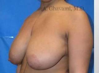 Breast Lift Before & After Patient #8831