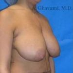 Breast Lift Before & After Patient #8831