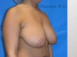 Breast Lift Before & After Patient #8831