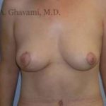 Breast Lift Before & After Patient #8824