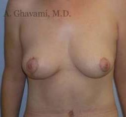 Breast Lift Before & After Patient #8824