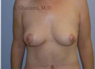 Breast Lift Before & After Patient #8824