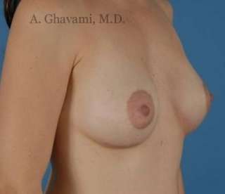 Breast Lift Before & After Patient #8824