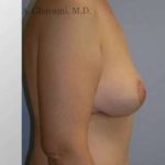 Breast Lift Before & After Patient #8824