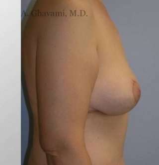 Breast Lift Before & After Patient #8824