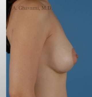 Breast Lift Before & After Patient #8824