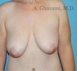 Breast Lift Before & After Patient #8824