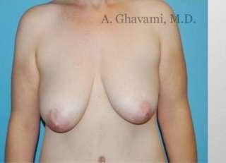 Breast Lift Before & After Patient #8824