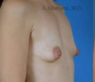 Breast Lift Before & After Patient #8824