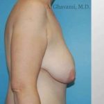 Breast Lift Before & After Patient #8824