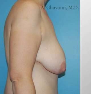 Breast Lift Before & After Patient #8824