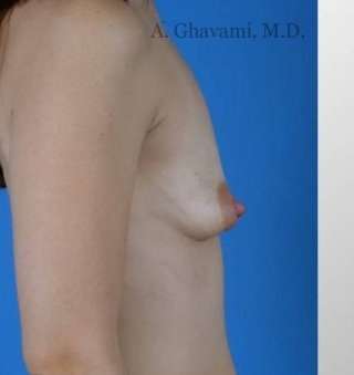 Breast Lift Before & After Patient #8824