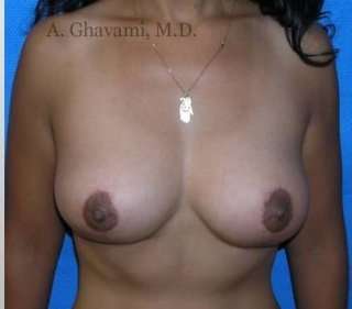 Breast Lift Before & After Patient #8815