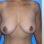 Breast Lift Before & After Patient #8815