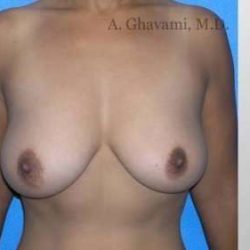 Breast Lift Before & After Patient #8815