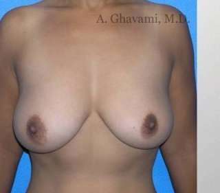 Breast Lift Before & After Patient #8815