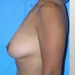 Breast Lift Before & After Patient #8815