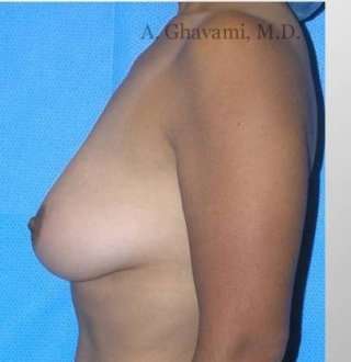 Breast Lift Before & After Patient #8815