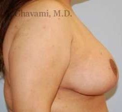 Breast Lift Before & After Patient #8810
