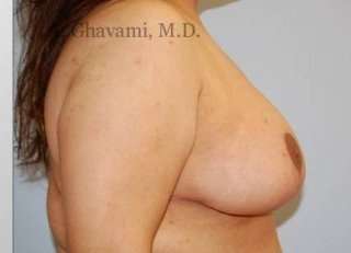 Breast Lift Before & After Patient #8810
