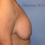 Breast Lift Before & After Patient #8810