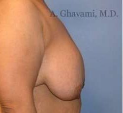 Breast Lift Before & After Patient #8810
