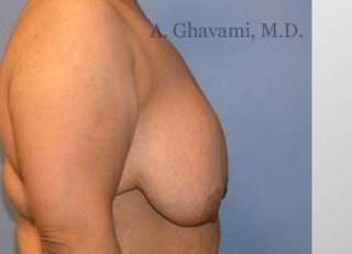 Breast Lift Before & After Patient #8810