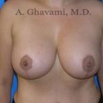 Breast Lift Before & After Patient #8807