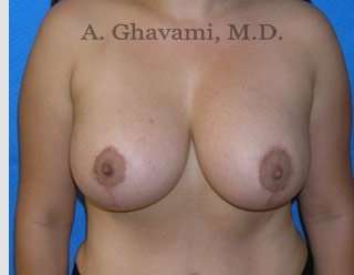 Breast Lift Before & After Patient #8807