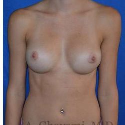 Breast Augmentation Before & After Patient #9088